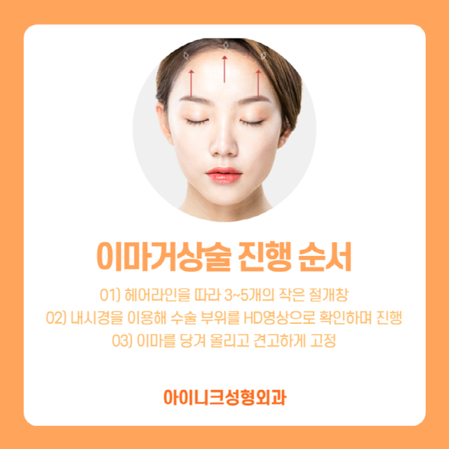Forehead Lift Surgery for Safety? Endotine image 4
