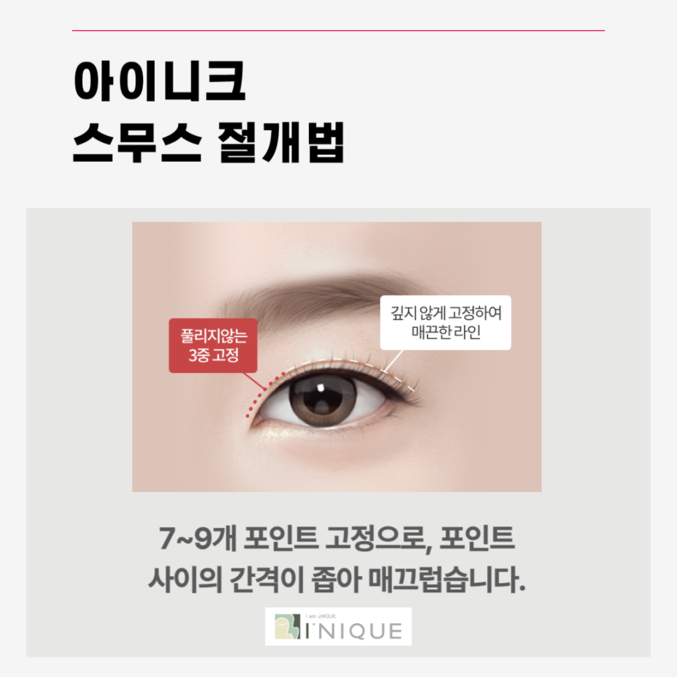 Types of Double Eyelid Surgery: Which Method Is Right for Me? image 3