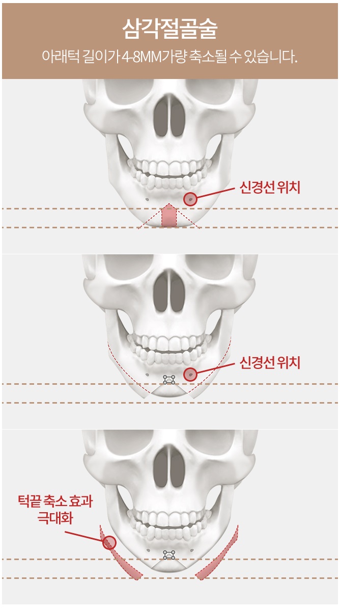 턱끝축소술부작용 없이 안전한 수술 관련 이미지 6