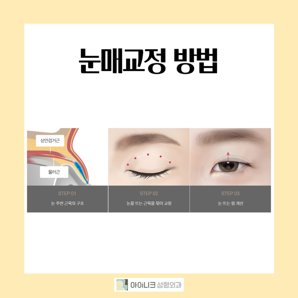 What Are the Reasons Double Eyelid Surgery Fails, and What Is the Right Revision Method? image 5