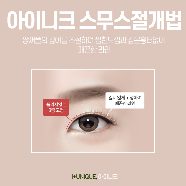 쌍꺼풀수술절개 그리고 매몰 부작용을 최소화하자. 관련 이미지 3