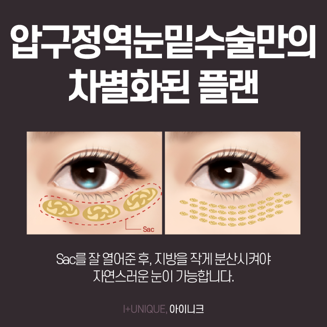 압구정역눈밑수술 과도한 눈지방이 고민이라면 관련 이미지 5
