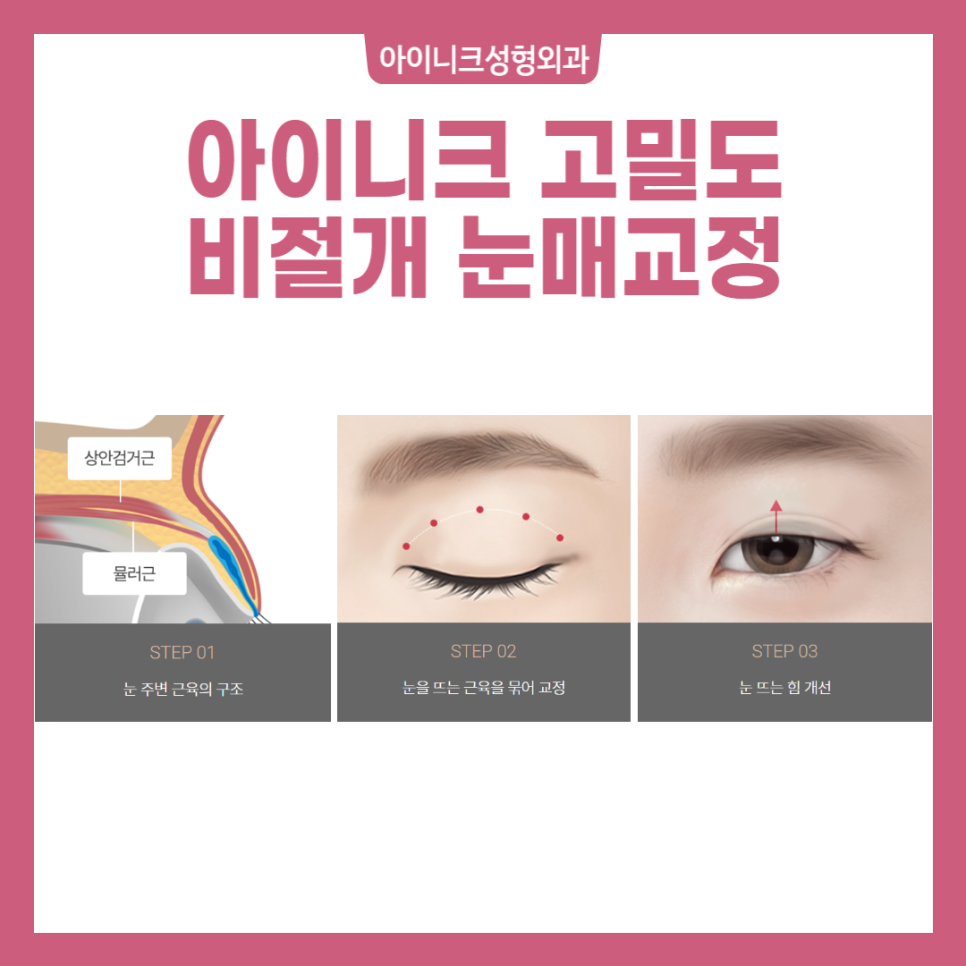 안검하수재수술 하지 말고, 처음부터 완벽하게 관련 이미지 4