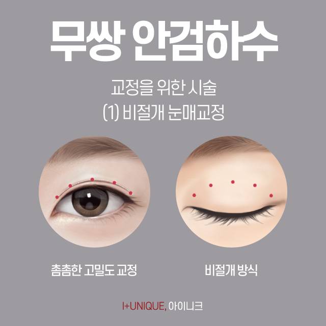 Where is the Most Natural Place to Improve Ptosis Without Double Eyelids? image 4