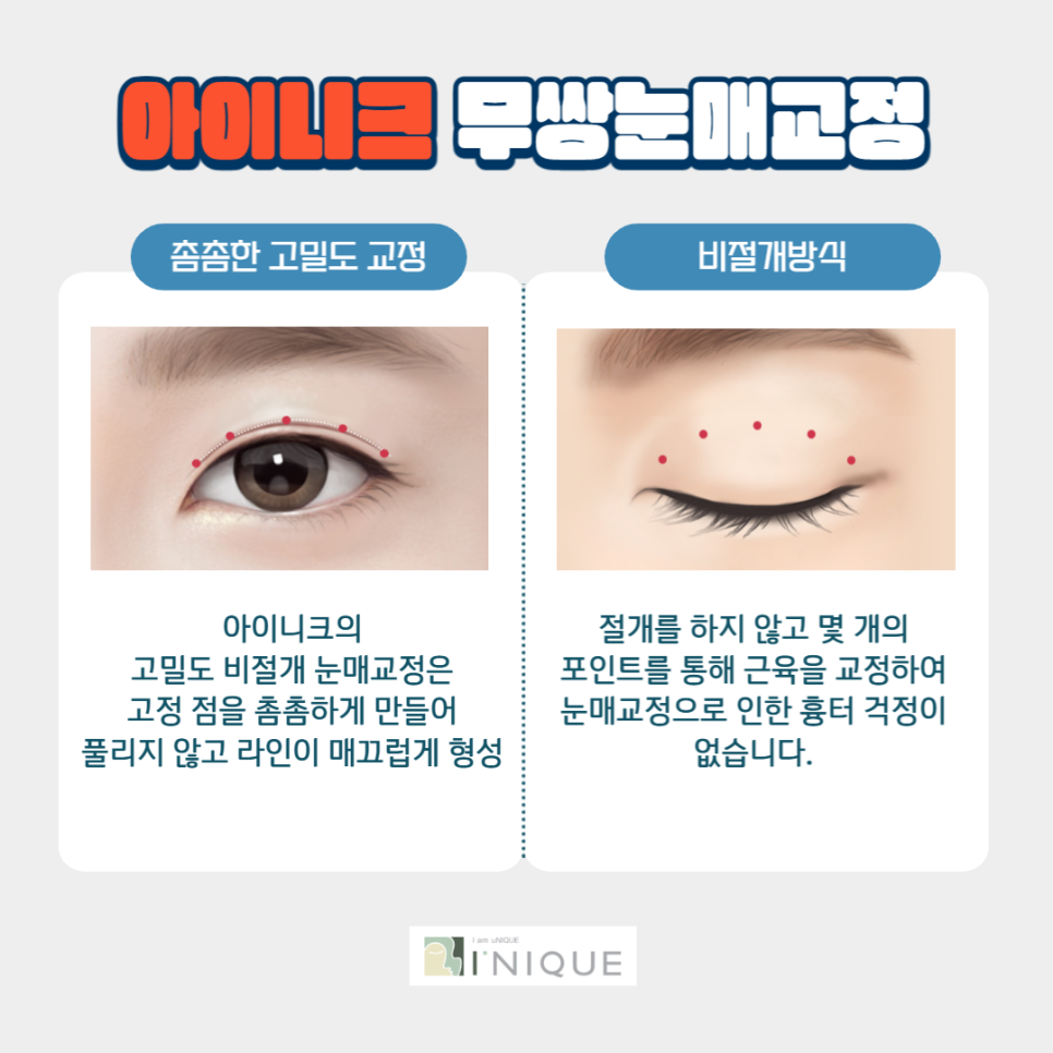 남자눈성형잘하는곳, 자연스럽고 또렷한 눈! 관련 이미지 5