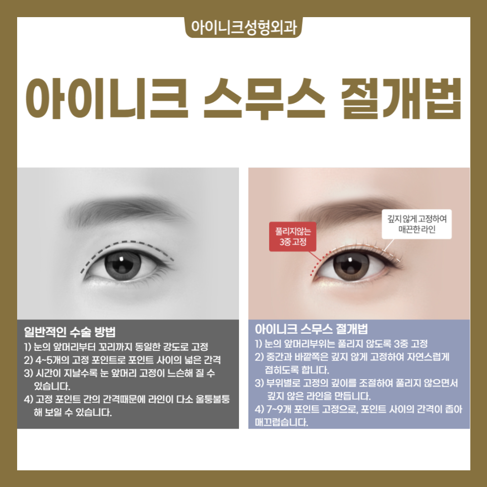 쌍꺼풀 절개법 매몰법 차이점은? 관련 이미지 3