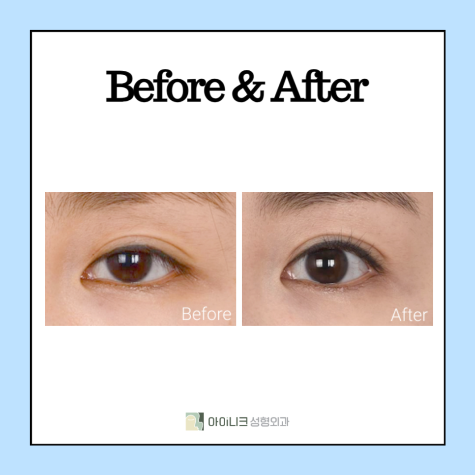 If You're Curious About Eye Correction Surgery Methods? image 5