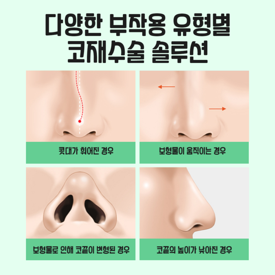 코재수술비용보다 중요한 것은 병원선택 관련 이미지 4