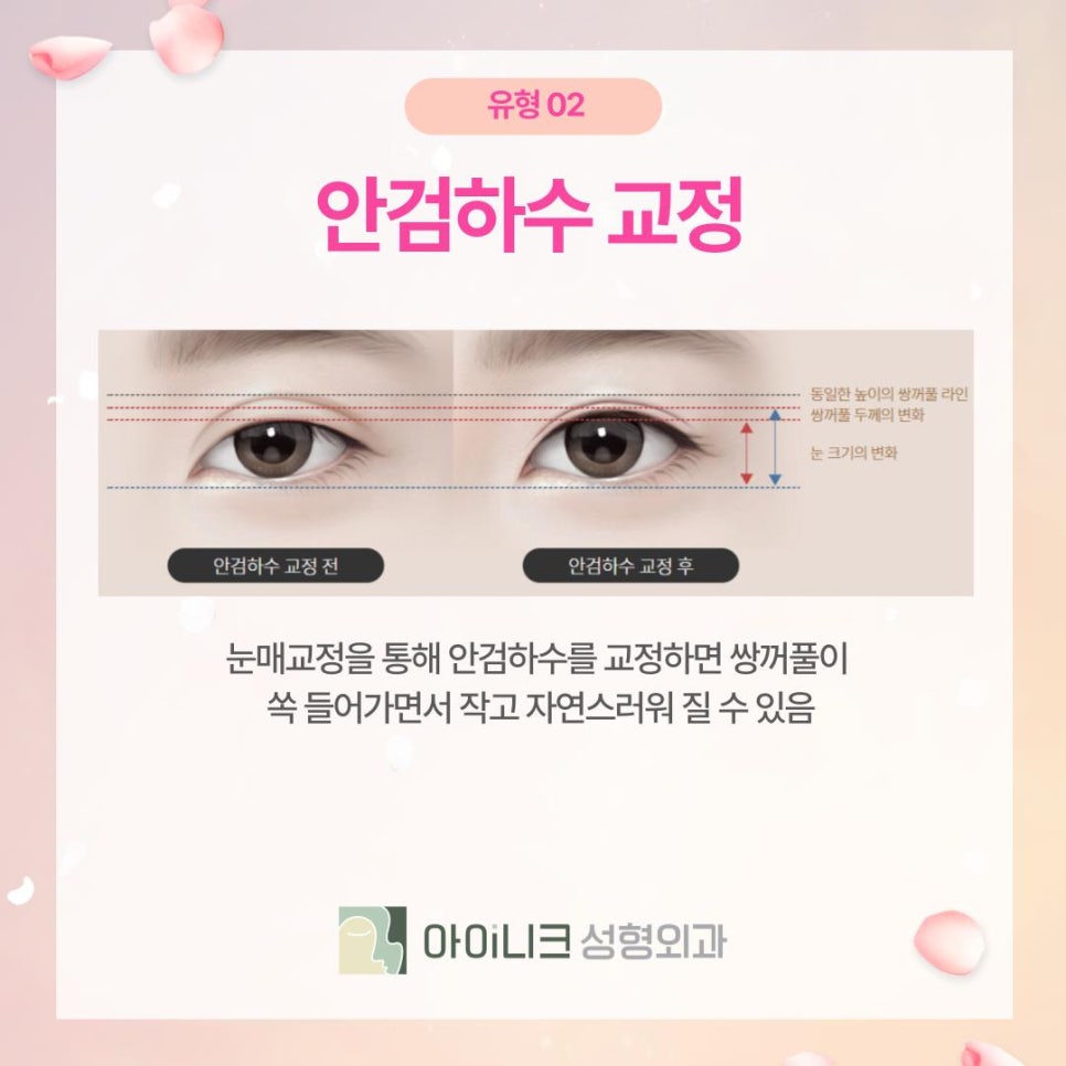 Where to Go for Revision Double Eyelid Surgery: Naturally Correcting Puffy Sausage Eyes image 5