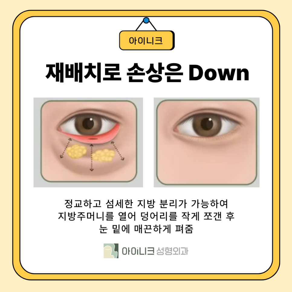 앙코르 눈밑지 레이저 일반적인 방식과 차이점 관련 이미지 6