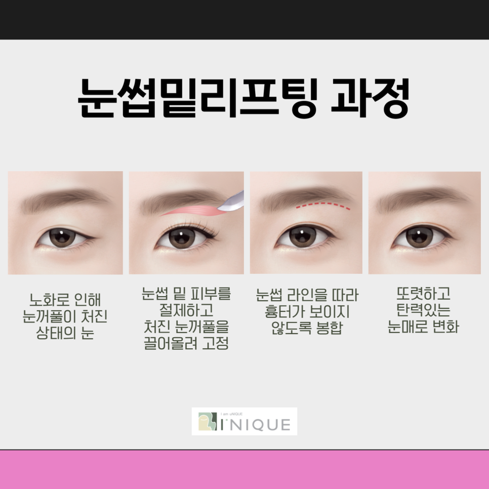 Are You Worried About Sagging Eyelids in Middle Age? image 3