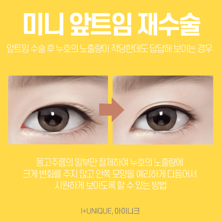 앞트임재건수술을 알아보고 있다면 이제는 아이니크성형외과로 결정하자 관련 이미지 4