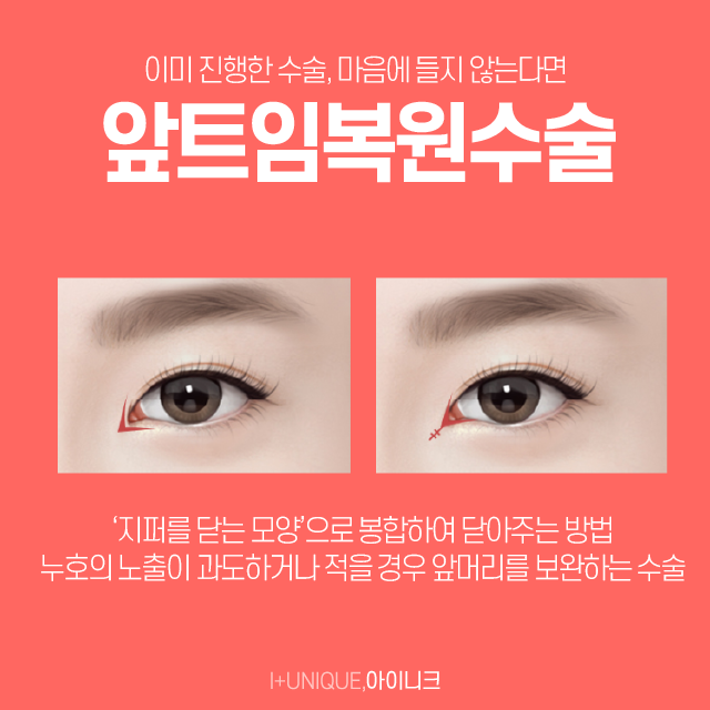 앞트임재수술로 자연스러운 눈 만들자! 관련 이미지 3