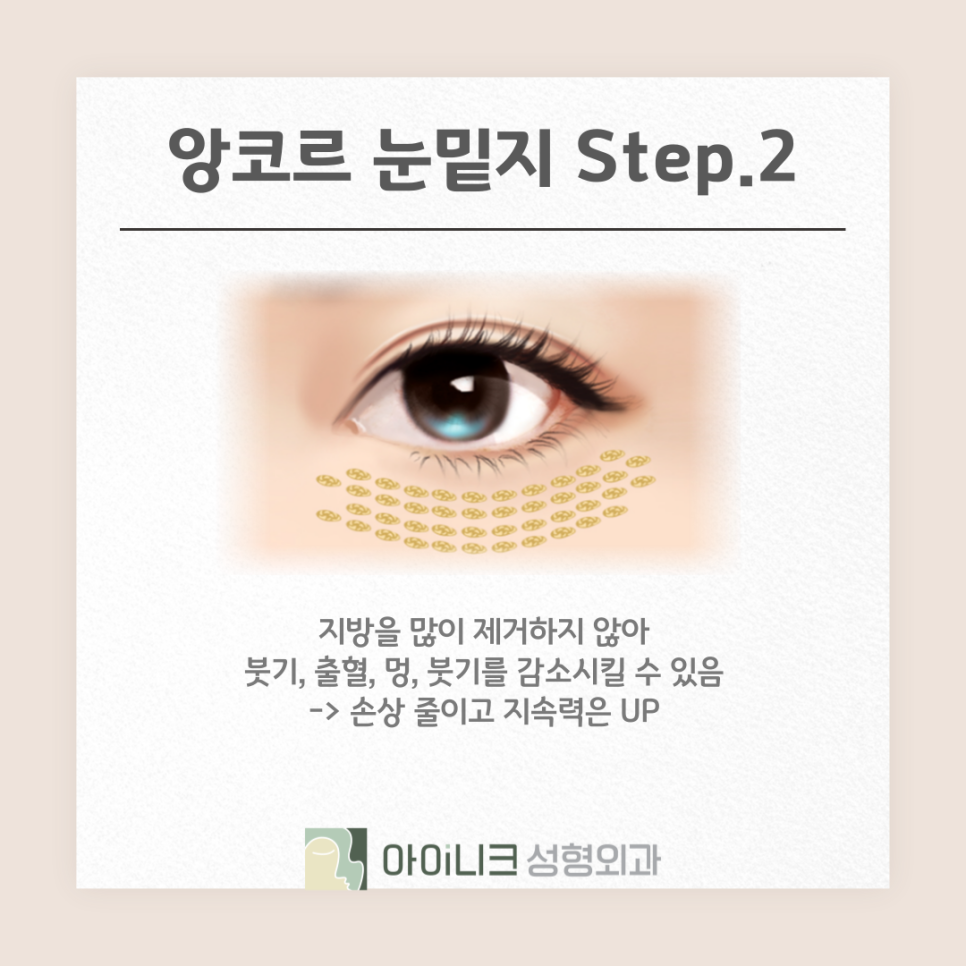 앙코르 눈밑지 효과 붓기 멍 적은 방법으로 관련 이미지 10