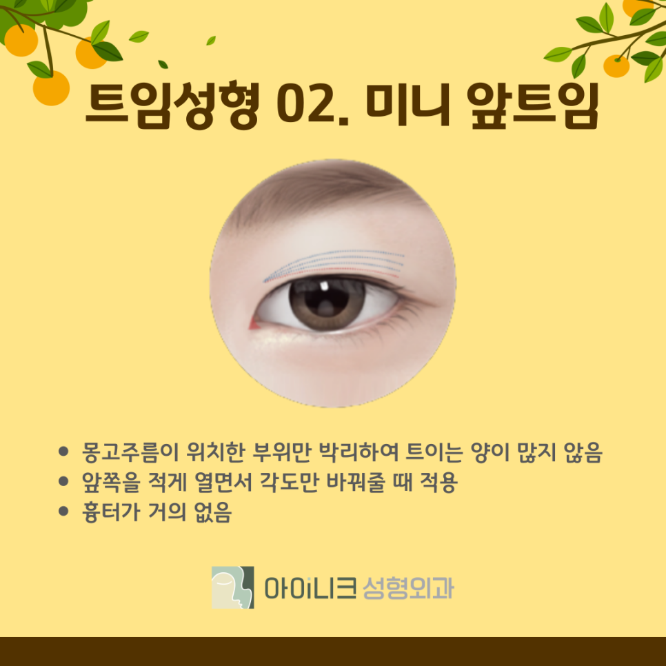 눈트임 수술 종류 나에게 맞는 방법은? 관련 이미지 8