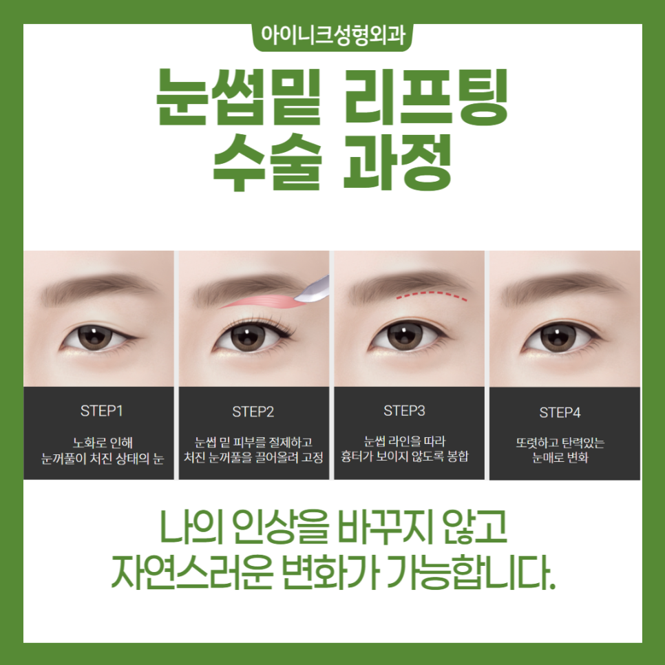 서울중년눈성형 다시 20대의 눈매로 관련 이미지 4