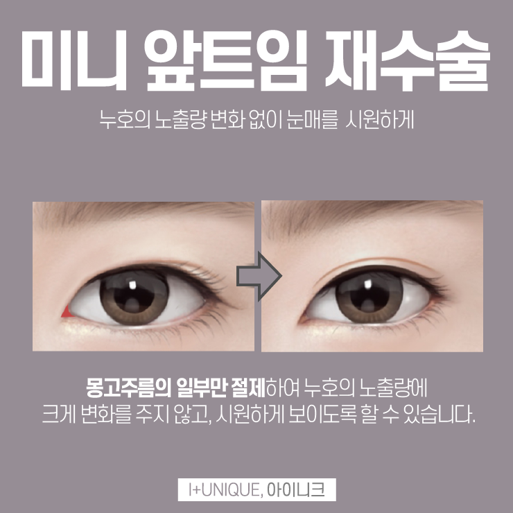 아이니크성형외과에서 트임재수술로 다시 또렷하게 관련 이미지 4