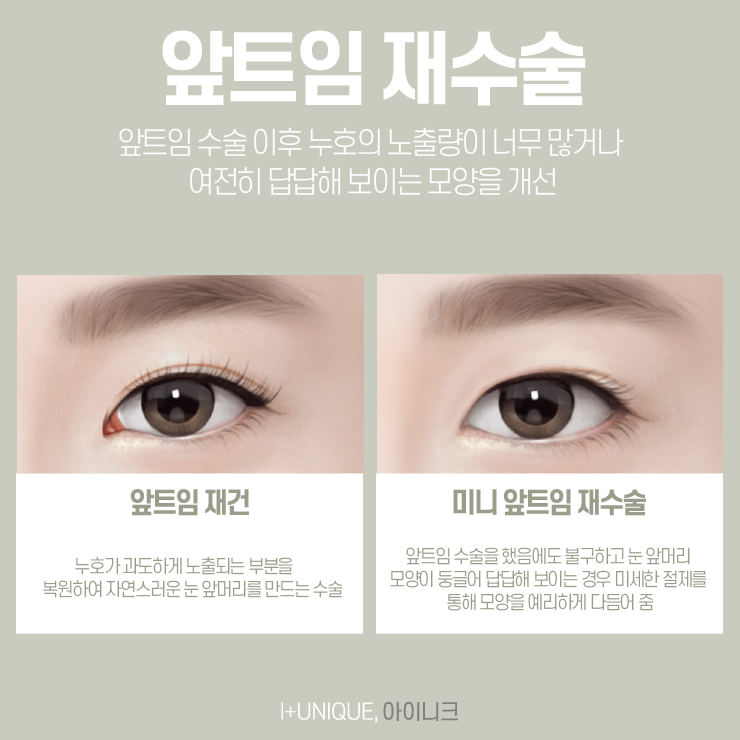 눈재성형을 고민하고 있다면, 믿을 수 있는 아이니크성형외과에서 관련 이미지 5