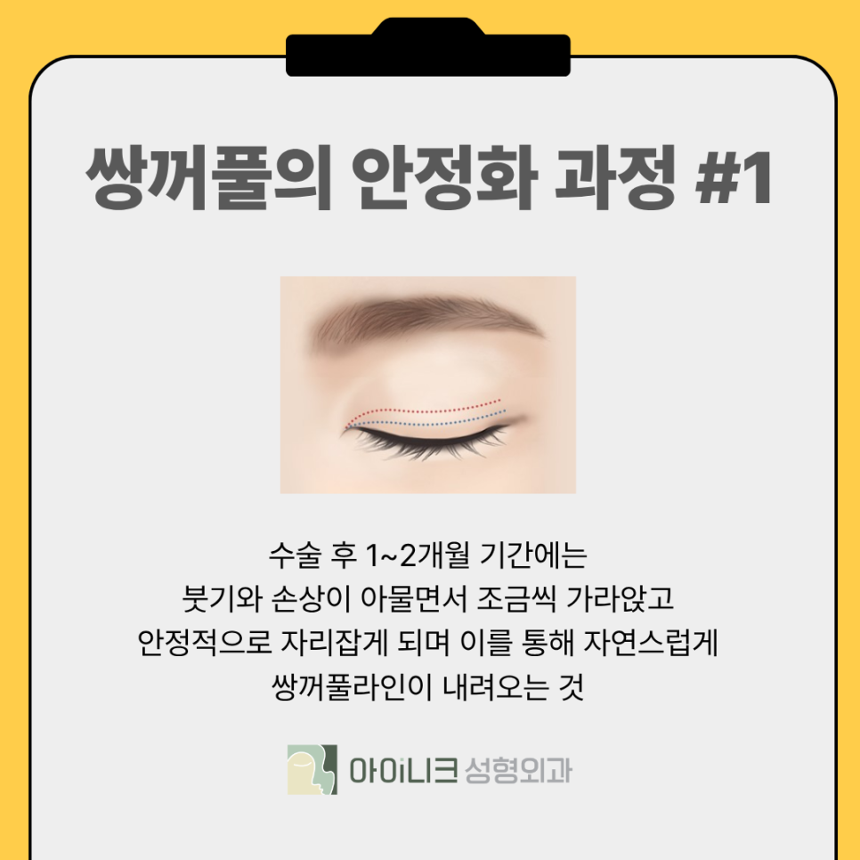 Why Does the Double-Eyelid Line Keep Getting Thinner? image 6