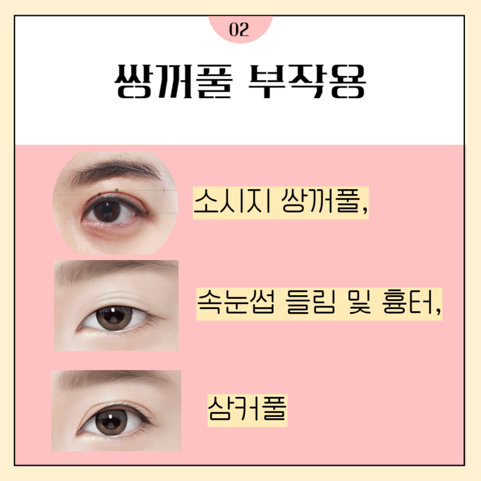 눈재수술병원 마지막이 되도록 관련 이미지 2