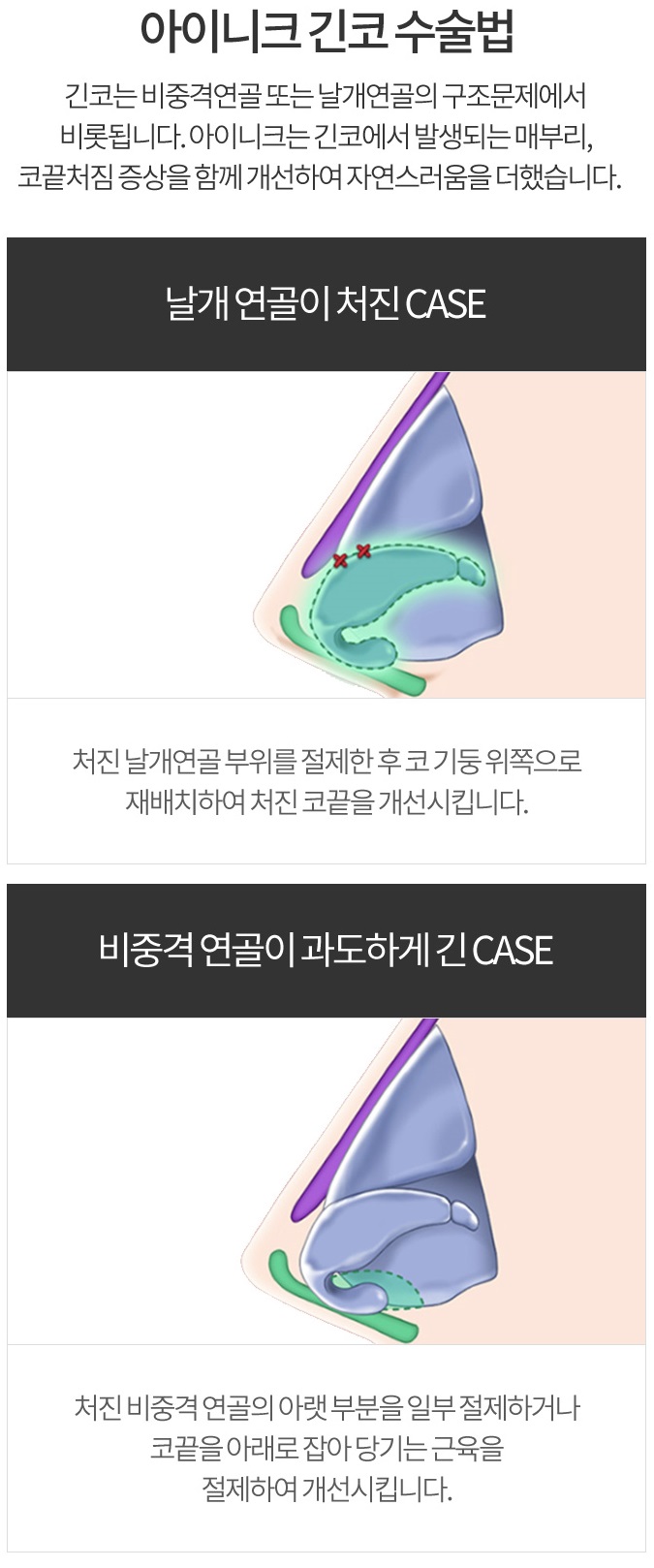 남자화살코성형 이상적인 비율로 변신! 관련 이미지 3