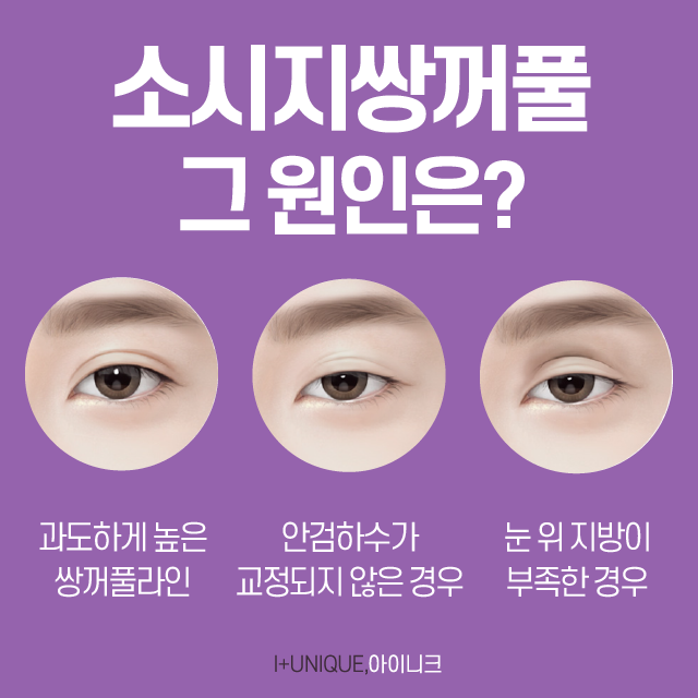 눈재수술유명한곳 제대로 찾는다면? 관련 이미지 2