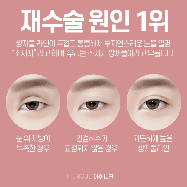 거울 볼 때마다 속상한 내 눈, 쌍커풀재수술병원에서 알아보자 관련 이미지 2