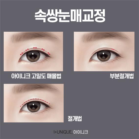 남자눈재수술 잘하는 곳 궁금하다면 관련 이미지 3