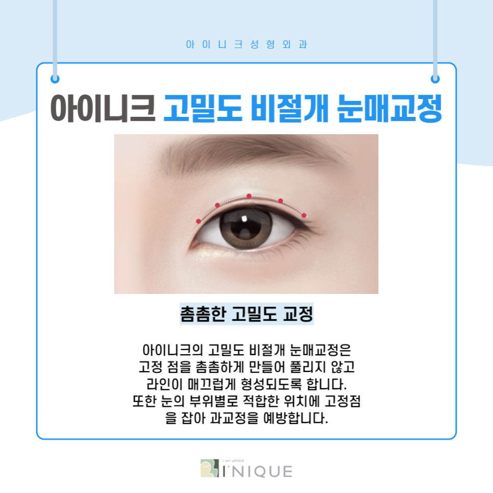 눈매과교정, 부작용을 예방하려면? 관련 이미지 3