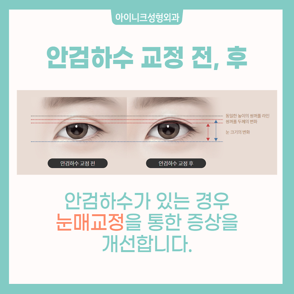 눈재수술성형외과에서 소시지 눈 고민 해결! 관련 이미지 4
