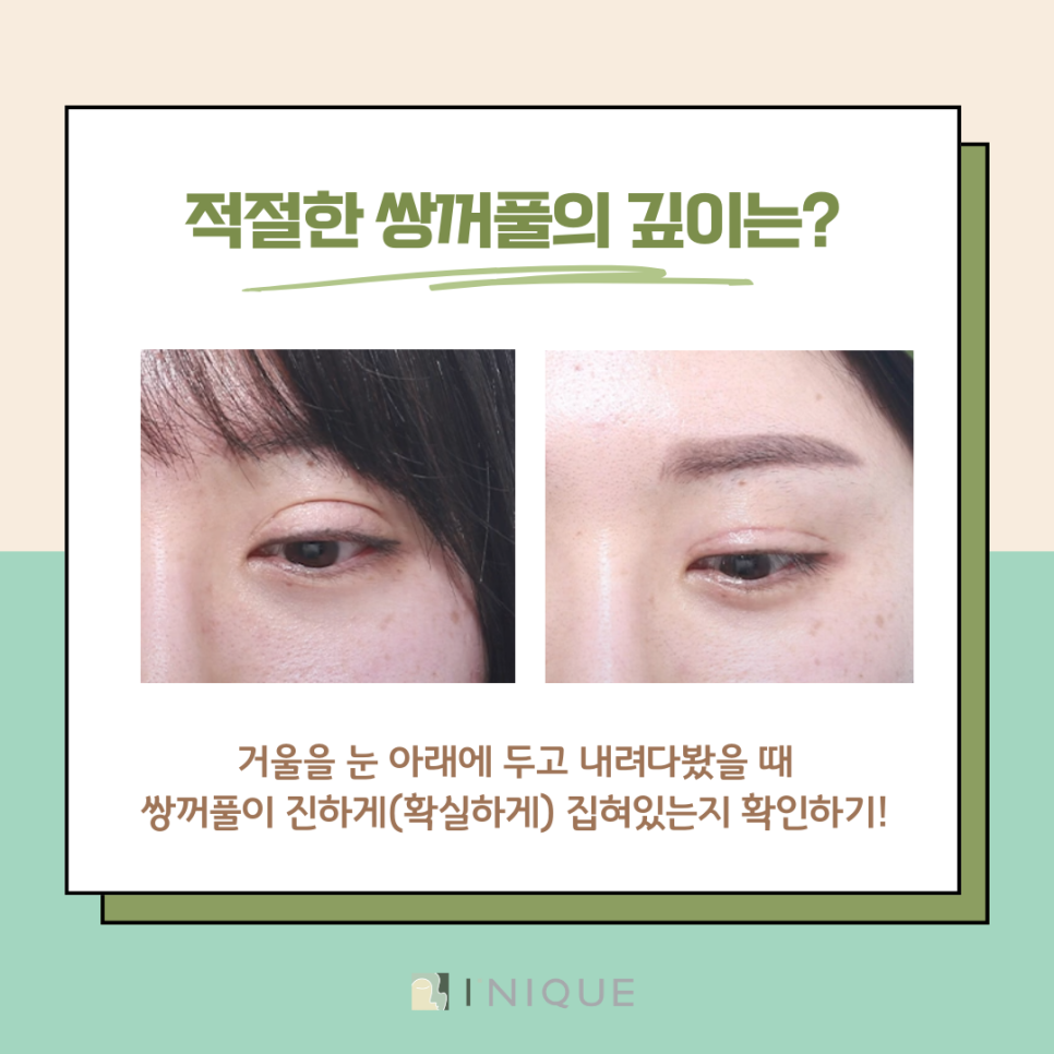 What Is the Solution for Unnatural Double Eyelids at a Place Known for Revision Eyelid Surgery in Apgujeong? image 6