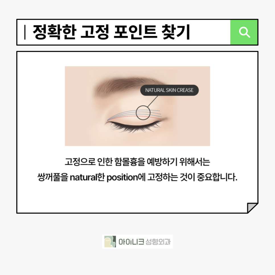 눈성형재수술, 고민하고 있다면 관련 이미지 3