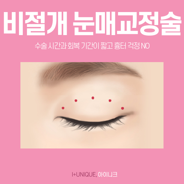 졸린 눈이 고민이라면 졸린눈성형인 눈매교정술로 또렷한 눈으로 거듭나기! 관련 이미지 4