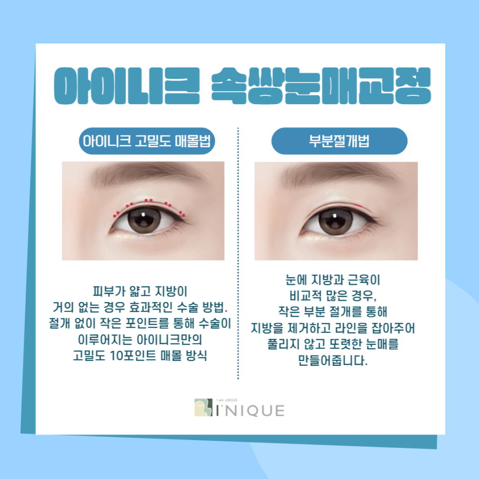 남자짝눈교정, 더 자연스럽고 또렷하게! 관련 이미지 2