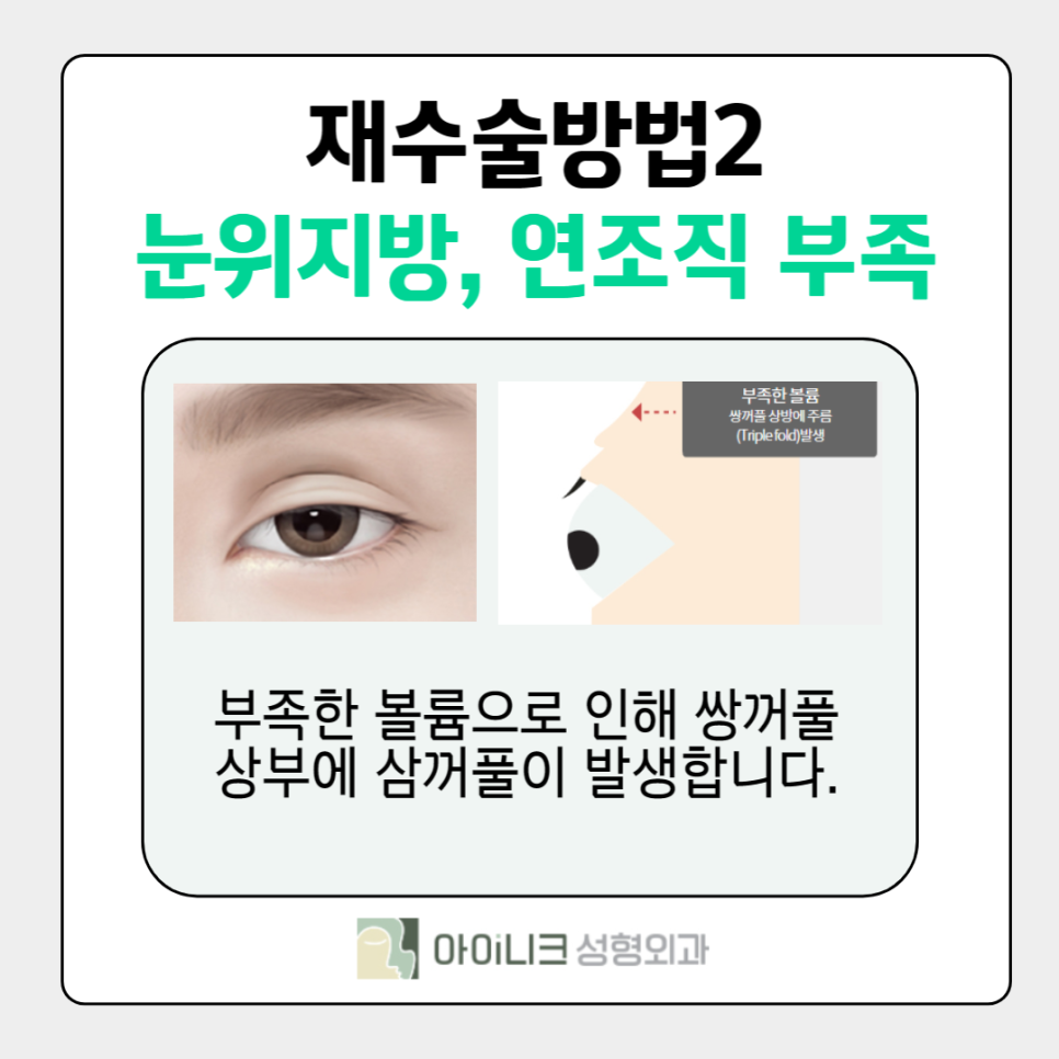 If You’re Curious About How to Fix Multiple Eyelid Folds image 4