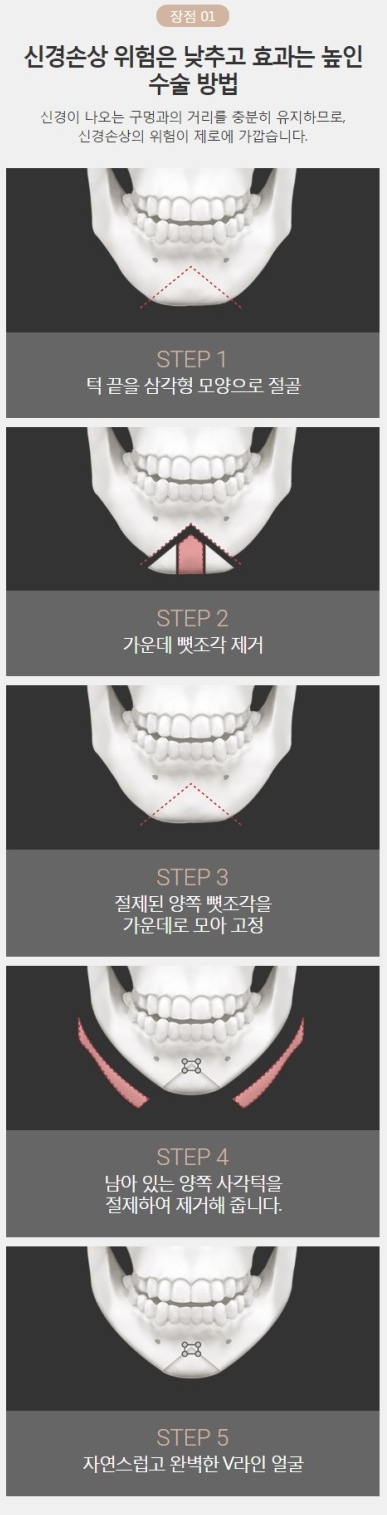 턱끝절골술 양악 없이도 완벽한 얼굴라인! 관련 이미지 4