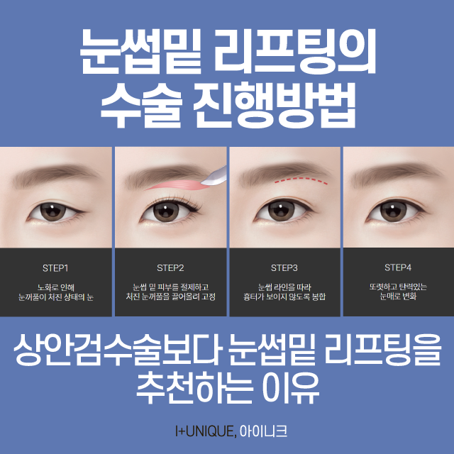 40대눈성형 고민하고 있다면? 관련 이미지 3