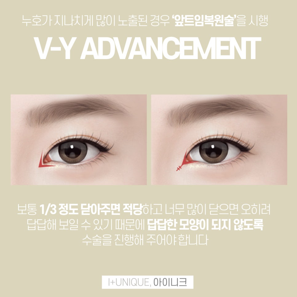 자연스러운 앞트임성형 아이니크성형외과에서 관련 이미지 3