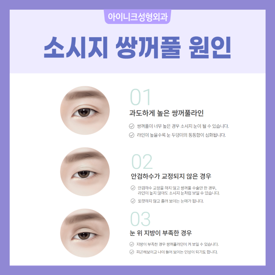 소세지쌍꺼풀 재수술 걱정 마세요! 관련 이미지 3