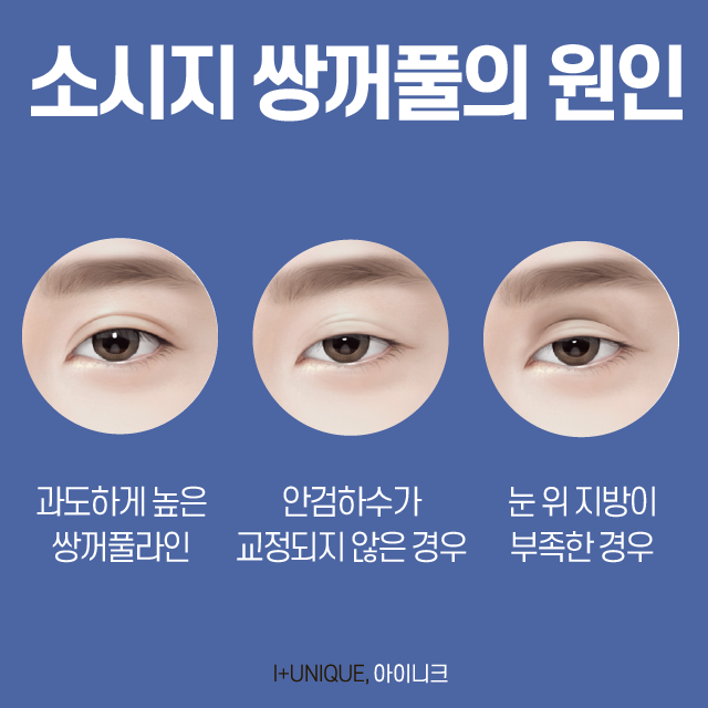 Must-Read: How to Avoid Failed Double Eyelid Revision Surgery image 2