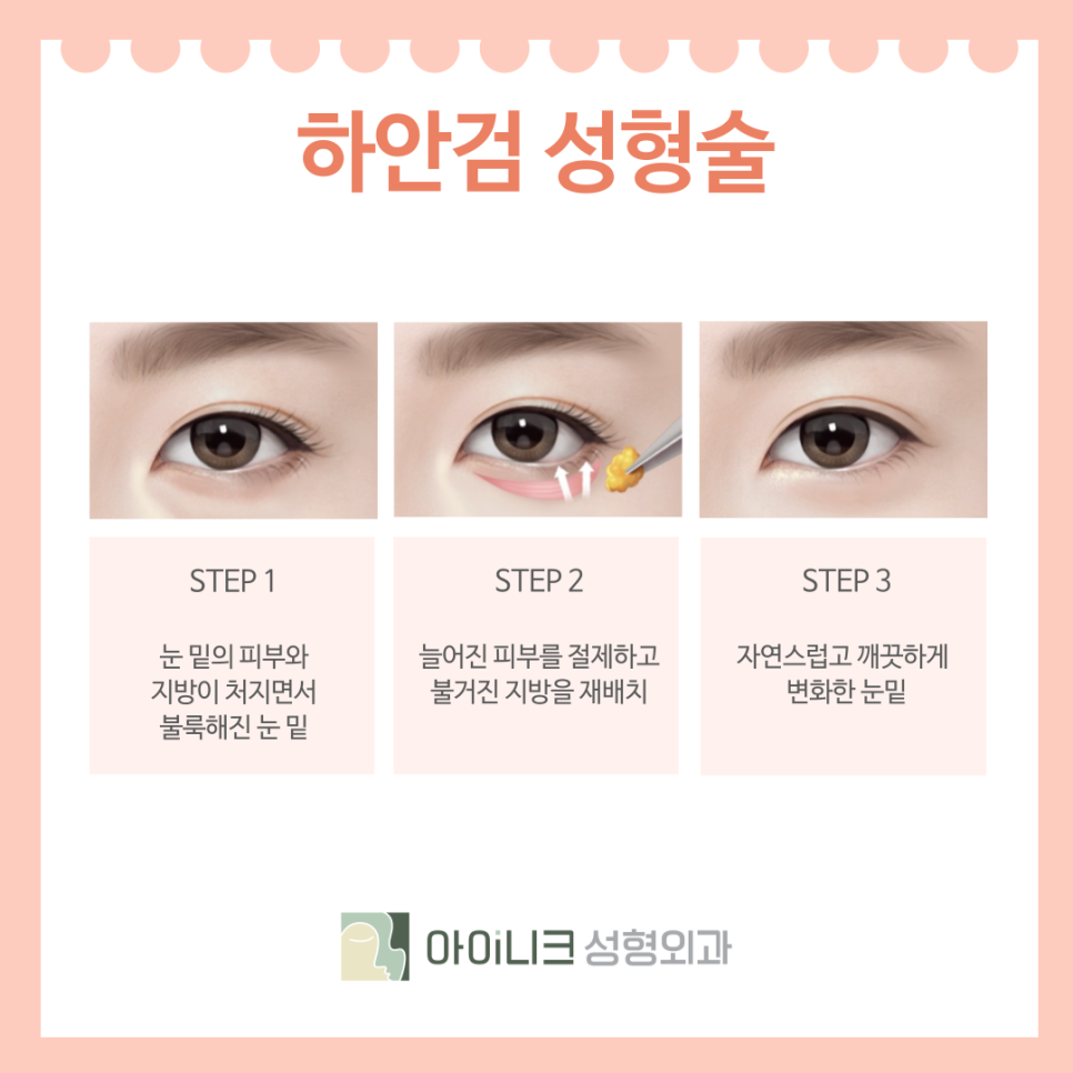 How to Turn Back Time with Eyelid Revision Surgery in Seoul for Middle-Aged Patients image 7