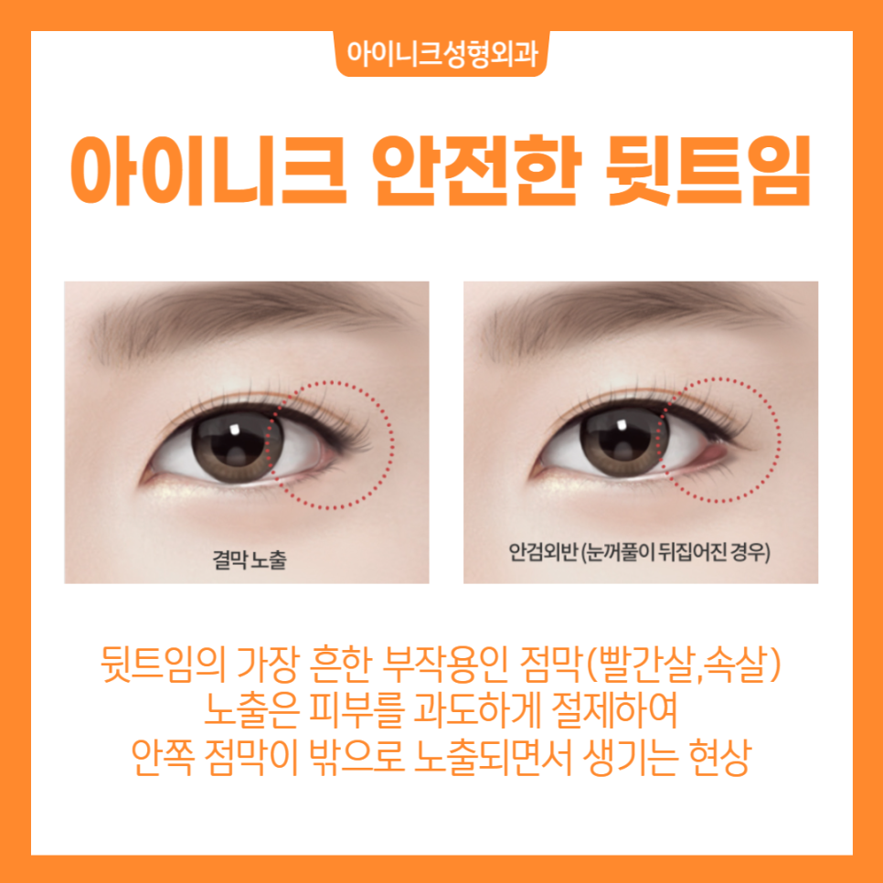 눈트임수술, 내 눈에 딱 맞게 선택하세요 관련 이미지 5