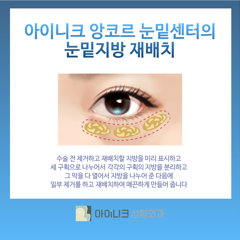 눈밑지방재배치효과 앙코르 눈밑센터에서 개선하기 관련 이미지 4
