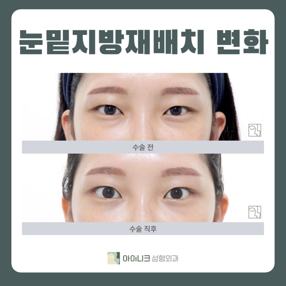 압구정눈밑지방재배치 새로운 수술법 관련 이미지 2