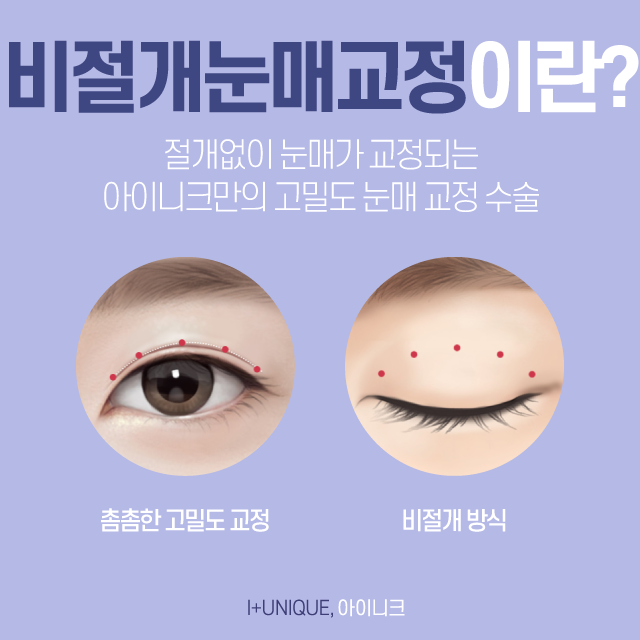 비절개눈매교정 수술로 첫인상 바꾸기 관련 이미지 4