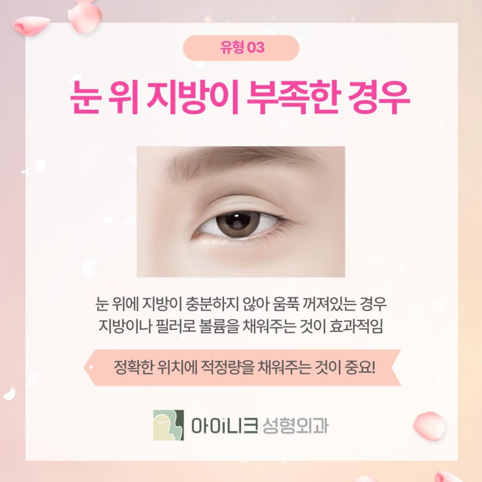 Where to Go for Revision Double Eyelid Surgery: Naturally Correcting Puffy Sausage Eyes image 6