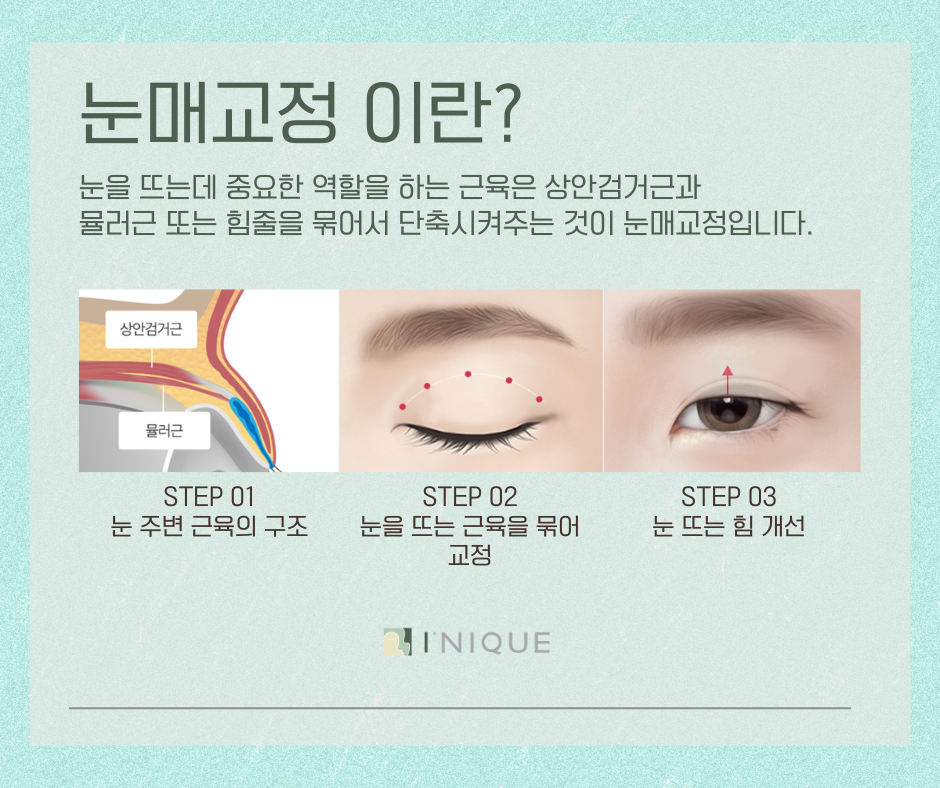 눈매교정잘하는곳 궁금하다면? 관련 이미지 3