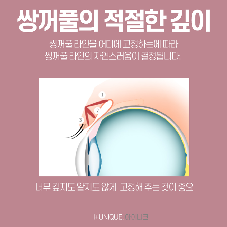 눈수술잘하는곳을 알아보려면 아이니크성형외과와 이것부터 알아보자 관련 이미지 4