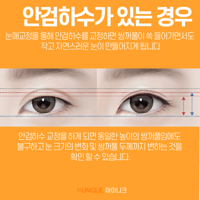 눈성형재수술, 어떻게 하면 자연스럽게 되돌릴 수 있을까 관련 이미지 5
