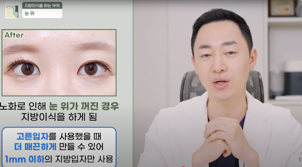 Look Younger with Gangnam Encore Under-Eye Fat Grafting! image 9